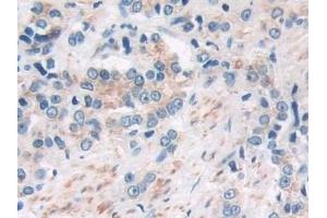 Detection of SIRT4 in Human Prostate cancer Tissue using Polyclonal Antibody to Sirtuin 4 (SIRT4) (SIRT4 antibody  (AA 28-314))