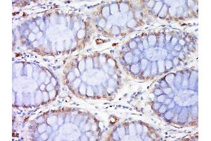 Paraformaldehyde-fixed, paraffin embedded human colon cancer, Antigen retrieval by boiling in sodium citrate buffer (pH6) for 15min, Block endogenous peroxidase by 3% hydrogen peroxide for 30 minutes, Blocking buffer (BSA or normal goat serum) at 37°C for 20min, Antibody incubation with Rad51 Polyclonal Antibody, Unconjugated  at 1:200 overnight at 4°C, followed by a conjugated secondary (sp-0023) for 20 minutes and DAB staining. (RAD51 antibody  (AA 81-180))