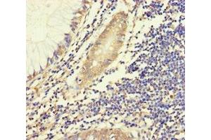 Immunohistochemistry of paraffin-embedded human colon cancer using ABIN7155943 at dilution of 1:100 (Chromosome X Open Reading Frame 27 (CXORF27) (AA 1-117) antibody)