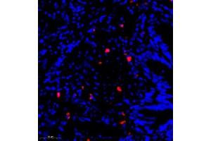 Immunofluorescence of paraffin embedded human lung cancer using CST9L (ABIN7073650) at dilution of 1:900 (300x lens) (CST9L antibody)