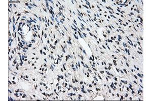 Immunohistochemical staining of paraffin-embedded Adenocarcinoma of breast tissue using anti-PSMD10 mouse monoclonal antibody. (PSMD10 antibody)