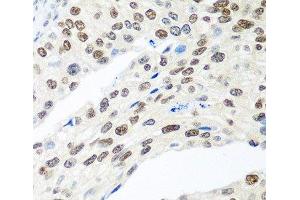 Immunohistochemistry of paraffin-embedded Human prostate cancer using MDC1 Polyclonal Antibody at dilution of 1:100 (40x lens). (MDC1 antibody)