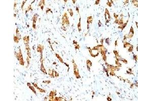 Formalin-fixed, paraffin-embedded human breast carcinoma stained with HSP27 antibody (SPM252)