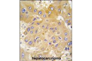 Formalin-fixed and paraffin-embedded human hepatocarcinoma tissue reacted with LAP3 antibody , which was peroxidase-conjugated to the secondary antibody, followed by DAB staining. (LAP3 antibody  (N-Term))