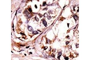 IHC analysis of FFPE human hepatocarcinoma tissue stained with the phospho-Syk antibody. (SYK antibody  (pTyr525, pTyr526))
