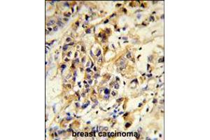 Formalin-fixed and paraffin-embedded human breast carcinoma reacted with RPGRIP1 Antibody , which was peroxidase-conjugated to the secondary antibody, followed by DAB staining. (RPGRIP1 antibody  (AA 530-557))
