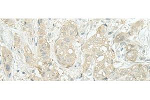 Immunohistochemistry of paraffin-embedded Human breast cancer tissue using MIEN1 Polyclonal Antibody at dilution of 1:45(x200) (C17orf37 antibody)