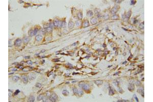 Immunohistochemical staining of paraffin-embedded human lung cancer tissue section with CXCL9 polyclonal antibody . (CXCL9 antibody  (N-Term))