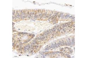 Immunohistochemistry of paraffin embedded human colon cancer using ATP1A1 (ABIN7073154) at dilution of 1: 500 (400x lens) (ATPase (Na/K) antibody)