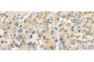 Immunohistochemistry of paraffin-embedded Human liver cancer tissue using TRAIP Polyclonal Antibody at dilution 1:40 (TRAIP antibody)