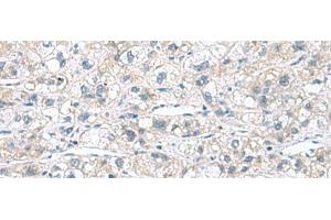 Immunohistochemistry of paraffin-embedded Human liver cancer tissue using CACNB1 Polyclonal Antibody at dilution of 1:110(x200) (CACNB1 antibody)