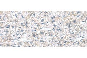 Immunohistochemistry of paraffin-embedded Human liver cancer tissue using CACNB1 Polyclonal Antibody at dilution of 1:110(x200)