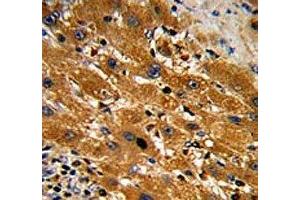 IHC analysis of FFPE human hepatocarcinoma with Caspase-9 antibody (Caspase 9 antibody  (Ser196))