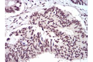 Immunohistochemical analysis of paraffin-embedded rectum cancer tissues using WTAP mouse mAb with DAB staining. (WTAP antibody  (AA 91-201))