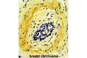 Formalin-fixed and paraffin-embedded human breast carcinomareacted with HTRA1 polyclonal antibody , which was peroxidase-conjugated to the secondary antibody, followed by AEC staining. (HTRA1 antibody  (AA 124-153))