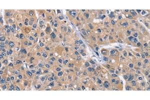 Immunohistochemistry of paraffin-embedded Human liver cancer tissue using CLEC2D Polyclonal Antibody at dilution 1:70 (CLEC2D antibody)