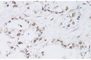 Immunohistochemistry of paraffin-embedded Human gastric cancer using PAX3 Polyclonal Antibody at dilution of 1:100 (40x lens). (Paired Box 3 antibody)