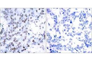 Immunohistochemistry analysis of paraffin-embedded human breast carcinoma tissue, using JunB (Ab-79) Antibody. (JunB antibody  (AA 46-95))