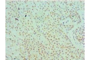 Immunohistochemistry of paraffin-embedded human breast cancer using ABIN7169345 at dilution of 1:100 (SERPINB5 antibody  (AA 21-189))