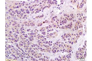 Formalin-fixed and paraffin embedded human endometrial carcinoma labeled with Anti-Notch1/MOTC Polyclonal Antibody, Unconjugated  at 1:200 followed by conjugation to the secondary antibody and DAB staining (Notch1 antibody  (AA 2101-2300))