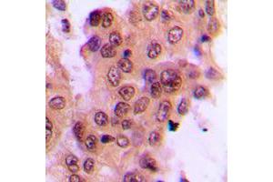 Immunohistochemical analysis of MKK4 (pT261) staining in human breast cancer formalin fixed paraffin embedded tissue section. (MAP2K4 antibody  (pSer261))