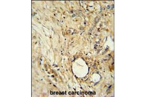 ITIH5 Antibody immunohistochemistry analysis in formalin fixed and paraffin embedded human breast carcinoma followed by peroxidase conjugation of the secondary antibody and DAB staining. (ITIH5 antibody  (C-Term))