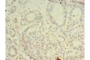 Immunohistochemistry of paraffin-embedded human breast cancer using ABIN7147697 at dilution of 1:100 (CBX2 antibody  (AA 1-211))