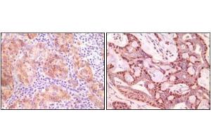Immunohistochemical analysis of paraffin-embedded human ovary carcinoma (left) and breast carcinoma (right), showing cytoplasmic(ovary carcinoma) localization, cytoplasmic and nuclear (breast carcinoma) localization using SNCG antibody with DAB staining. (SNCG antibody)
