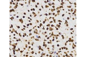 Immunohistochemistry of paraffin-embedded Human kidney cancer using DiMethyl-Histone H3-K27 Polyclonal Antibody at dilution of 1:200 (40x lens).