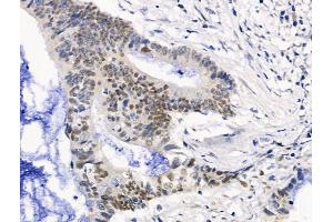 ABIN6263350 and ABIN6268864 at 1/100 staining Human colorectal cancer by IHC-P.