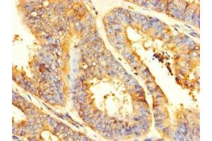Immunohistochemistry of paraffin-embedded human endometrial cancer using ABIN7154164 at dilution of 1:100 (GPD2 antibody  (AA 43-727))