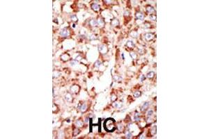 Formalin-fixed and paraffin-embedded human hepatocellular carcinoma tissue reacted with the ACSL3 polyclonal antibody  , which was peroxidase-conjugated to the secondary antibody, followed by DAB staining. (Acsl3 antibody  (N-Term))