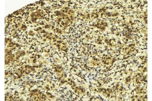 ABIN6272950 at 1/100 staining Human breast cancer tissue by IHC-P. (SPOP-B antibody  (Internal Region))