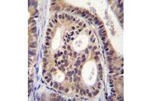 Formalin fixed, paraffin embedded human prostate carcinoma stained with CYTSA Antibody (N-term) followed which was peroxidase conjugated to the secondary antibody and followed by DAB staining. (SPECC1L antibody  (N-Term))