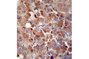 Immunohistochemistry analysis in human hepatocarcinoma using CHRDL1 / NRLN1  Antibody  (N-term), followed by peroxidase conjugation of the secondary antibody and DAB staining. (CHRDL1 antibody  (N-Term))