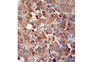 Immunohistochemistry analysis in human hepatocarcinoma using CHRDL1 / NRLN1  Antibody  (N-term), followed by peroxidase conjugation of the secondary antibody and DAB staining.