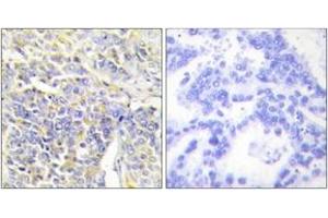 Immunohistochemistry analysis of paraffin-embedded human lung carcinoma tissue, using KAD1 Antibody . (Adenylate Kinase 1 antibody  (AA 101-150))