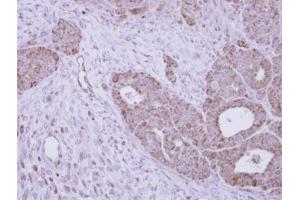 IHC-P Image Immunohistochemical analysis of paraffin-embedded NCI-N87 xenograft, using GALNS, antibody at 1:100 dilution. (GALNS antibody  (Center))