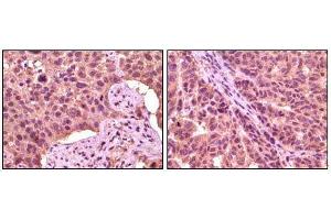Immunohistochemical analysis of paraffin-embedded human lung carcinoma (left) and skin carcinoma (right), showing cytoplasmic localization using GSK3 aphpa mouse mAb with DAB staining. (GSK3 alpha antibody)