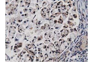 Immunohistochemical staining of paraffin-embedded Adenocarcinoma of Human colon tissue using anti-TACC3 mouse monoclonal antibody. (TACC3 antibody)