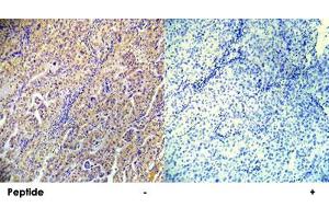 Immunohistochemical analysis of paraffin-embedded human lung carcinoma tissue using PRKAB1 (phospho S182) polyclonal antibody . (PRKAB1 antibody  (pSer182))