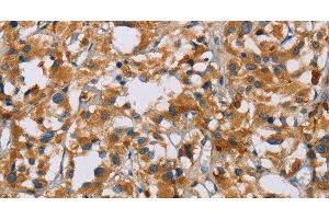 Immunohistochemistry of paraffin-embedded Human thyroid cancer tissue using NRN1 Polyclonal Antibody at dilution of 1:40