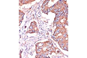 Immunohistochemistry of paraffin-embedded Human colon carcinoma using [KO Validated] IFITM3 Rabbit pAb (ABIN6130482, ABIN6142186, ABIN6142187 and ABIN7101416) at dilution of 1:100 (40x lens). (IFITM3 antibody  (AA 1-133))