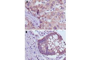 Immunohistochemical analysis of paraffin-embedded human liver cancer (A) and colorectal cancer tissue (B) using BDH1 monoclonal antibody, clone 1A5  with DAB staining.