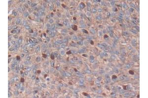 DAB staining on IHC-P; Samples: Human Skin cancer Tissue (S100A14 antibody  (AA 1-91))