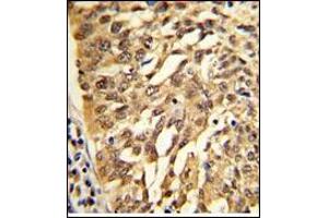 AP17730PU-N SAR1A Antibody (Center) staining of Formalin-Fixed, Paraffin-Embedded Human lung carcinoma. (SAR1A antibody  (Middle Region))