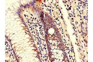 Immunohistochemistry of paraffin-embedded human colon cancer using ABIN7151322 at dilution of 1:100 (TRIM25 antibody  (AA 81-272))