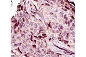 IHC analysis of FFPE human breast carcinoma tissue stained with the IRAK4 antibody (IRAK4 antibody  (AA 5-36))