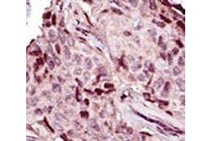 IHC analysis of FFPE human breast carcinoma tissue stained with the IRAK4 antibody