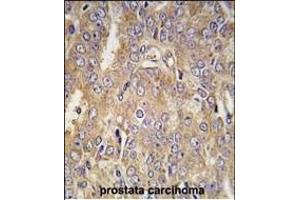Formalin-fixed and paraffin-embedded human prostata carcinoma tissue reacted with LTBP1 antibody (C-term) (ABIN392207 and ABIN2841907) , which was peroxidase-conjugated to the secondary antibody, followed by DAB staining. (LTBP1 antibody  (C-Term))